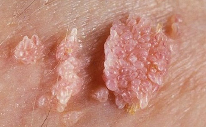 Sùi mào gà - Hình ảnh minh họa